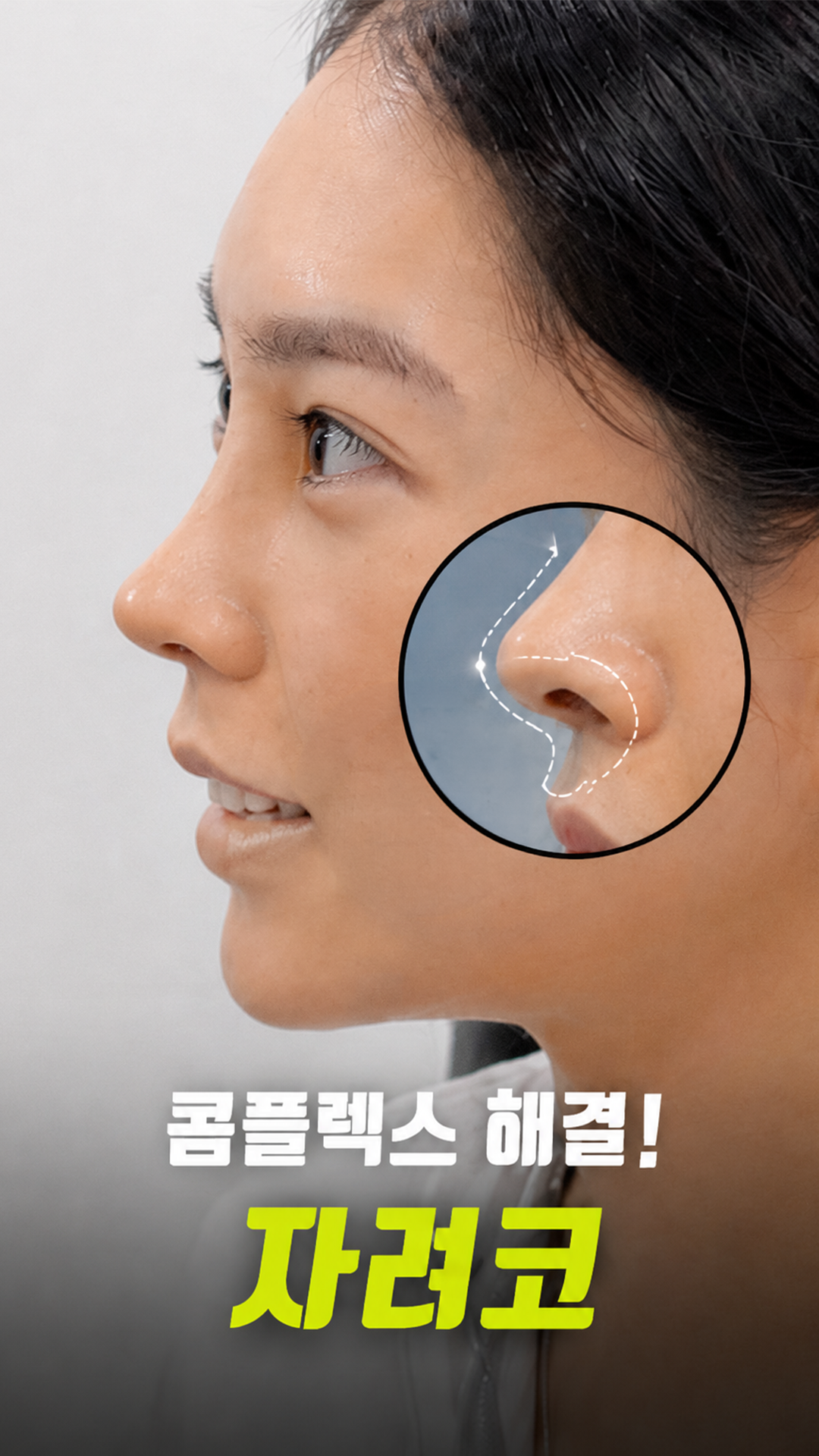 자가코 콤플렉스 해결