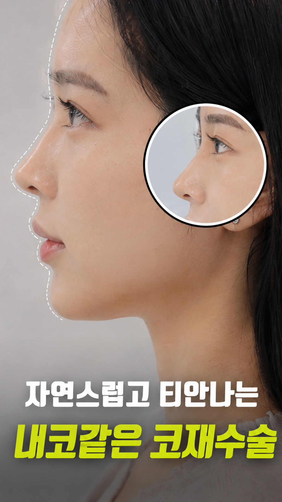 내 코 같은 코재수술
