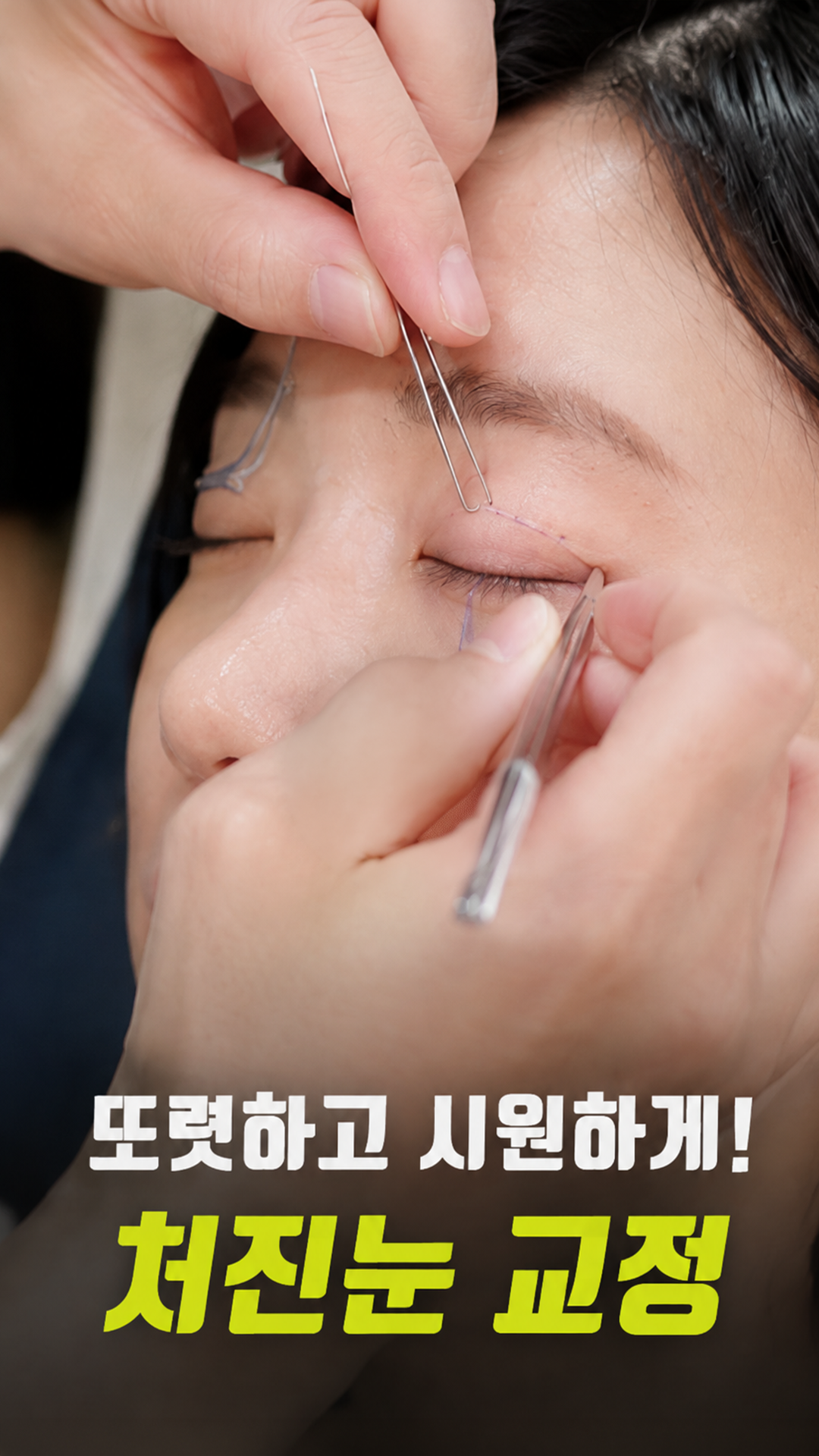 처진눈 교정